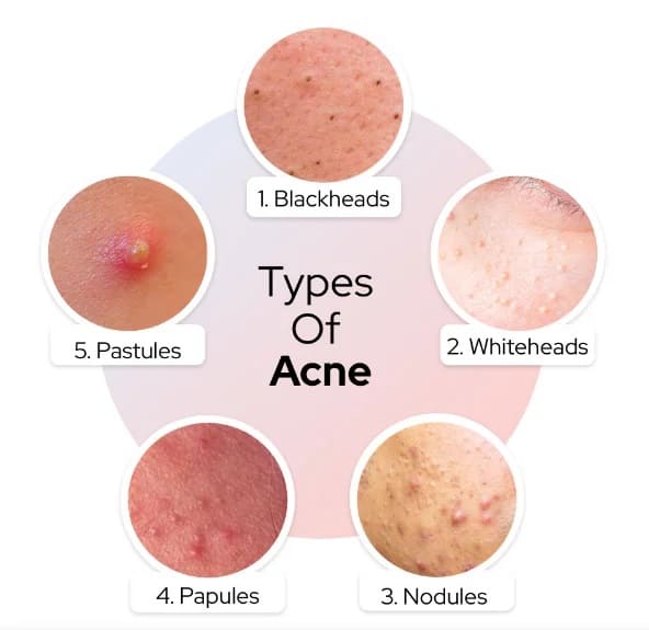 différentes formes d’acné
